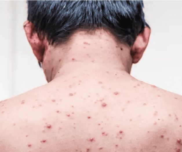 Ahora ataca la varicela