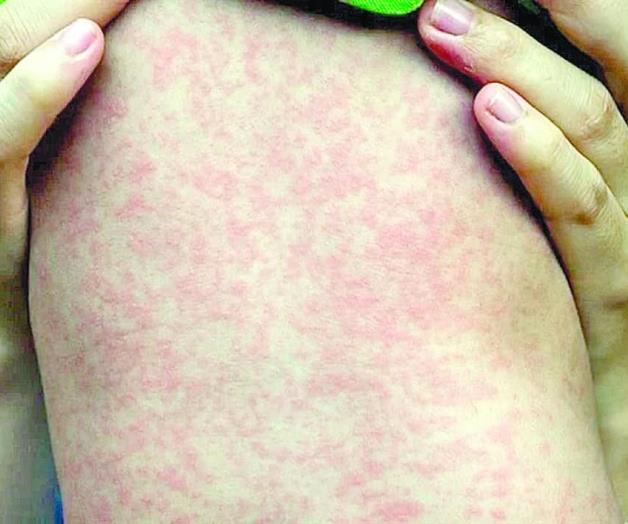 Urgen que Ssa aclare  repunte de sarampi&oacute;n