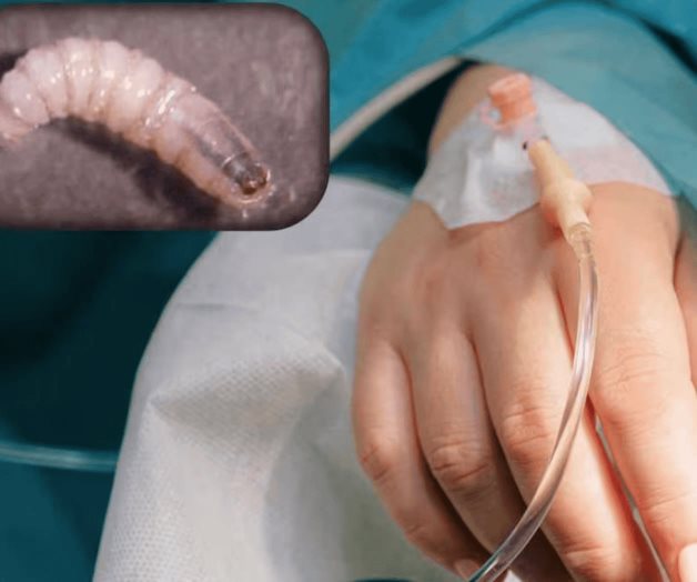 Cuatro personas hospitalizadas por gusano barrenador en Chiapas y Campeche Cuatro personas hospitalizadas por gusano barrenador en Chiapas y Campeche