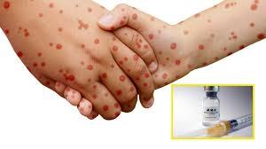 Alerta en Hidalgo por riesgo de contagio de sarampión