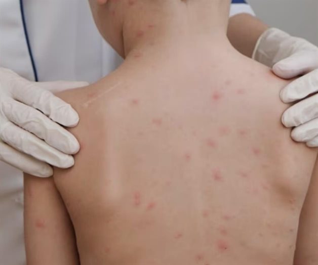 Avances en la vacunación contra el sarampión en Chihuahua