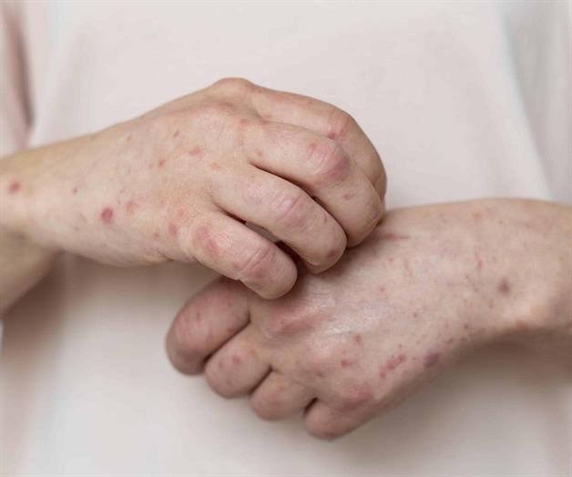 Dos escuelas de Reynosa y Tampico con alta cifra de alumnos con virus boca-pie-mano Dos escuelas de Reynosa y Tampico con alta cifra de alumnos con virus boca-pie-mano