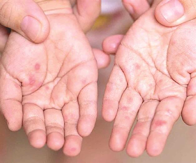 Ataca a niños infección viral; brota en tamaulipas enfermedad ´boca-mano-pie´