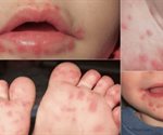 ¿En tu familia, vecinos o conocidos se han contagiado del virus mano-boca-pie?