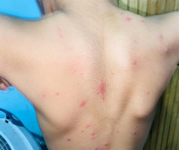 Suman 866 casos de virus manos-pie-boca en Tamaulipas