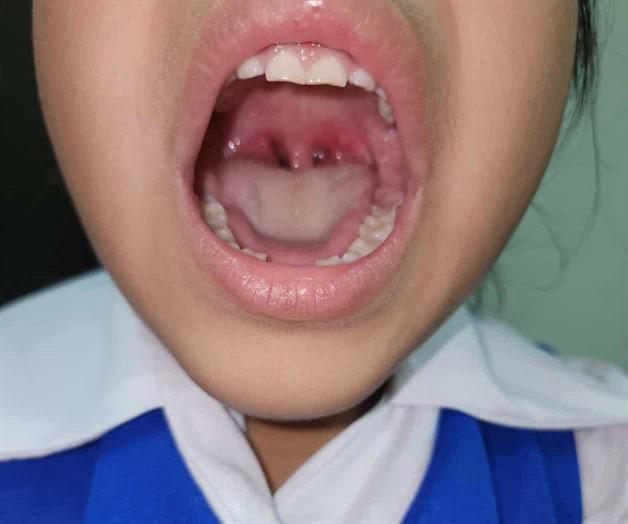 Nuevos brotes de coxsackie Nuevos brotes de coxsackie