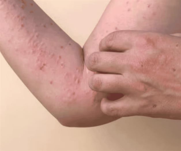 México confirma 78 nuevos casos de sarampión en una semana México confirma 78 nuevos casos de sarampión en una semana