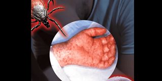 Detectan casos probables de Rickettsiosis en personas de Reynosa y Nuevo Laredo Detectan casos probables de Rickettsiosis en personas de Reynosa y Nuevo Laredo