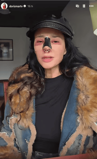 Dorismar muestra las consecuencias de una mala cirug&iacute;a est&eacute;tica