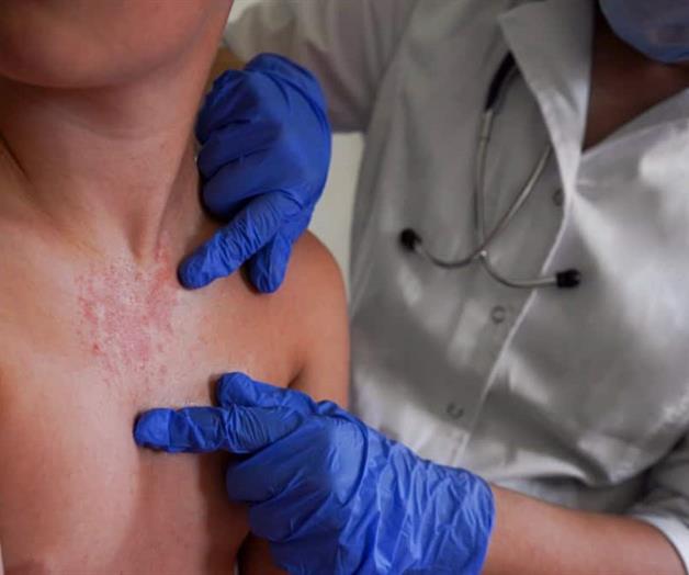 Descartan repunte de sarampi&oacute;n en Chiapas