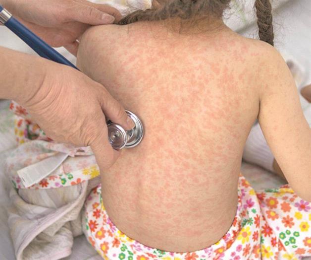 Exhortan a vacunarse contra el sarampi&oacute;n