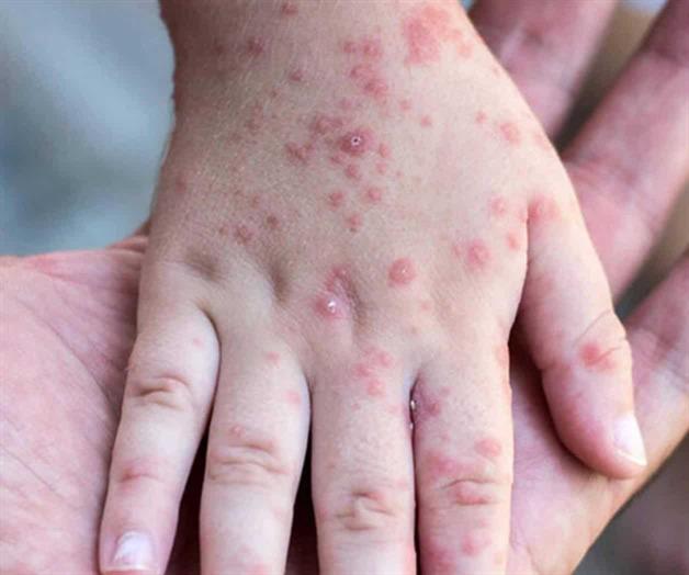 Refuerza vigilancia epidemiol&oacute;gica SS